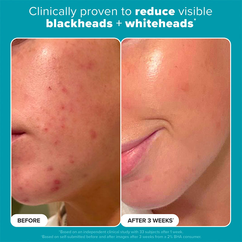 2% BHA Liquid Exfoliant